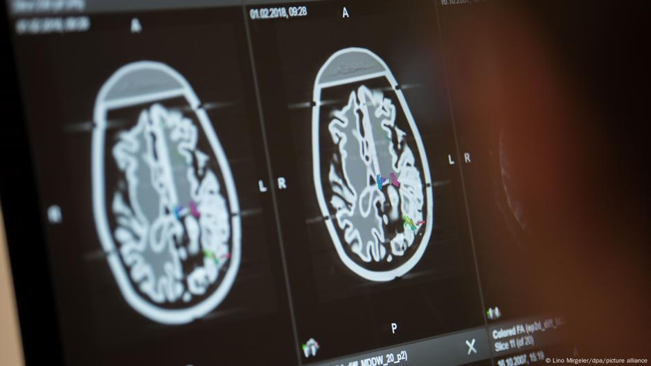 Neurochip im Gehirn: Münchner Ärzte geben gelähmtem Patienten neue Kontrolle Neurochip im Gehirn: Operation in München gibt Hoffnung