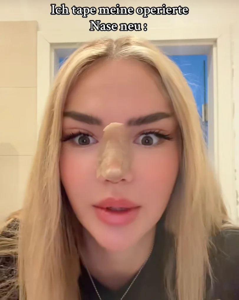 Emma Fernlund zeigt ihr Gesicht nach dreifacher Schönheits-OP